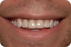 dental bridges