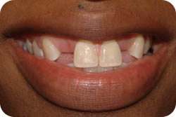 dental implants