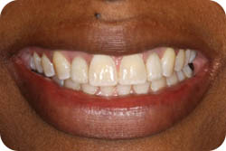 dental implants